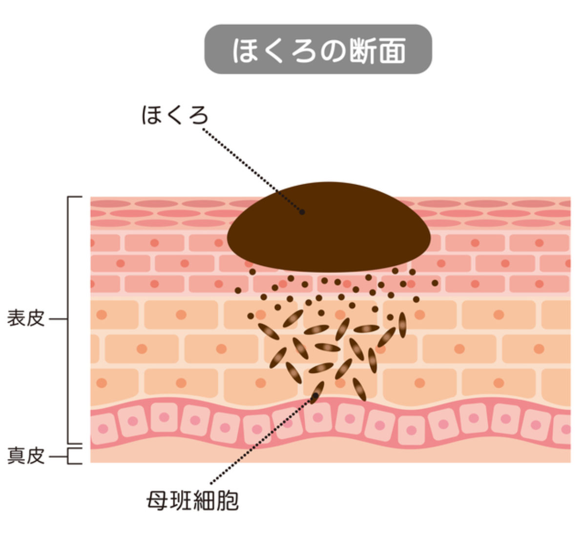 関西医科大学が ほくろを自然消滅させる仕組みを解明 大学ジャーナルオンライン