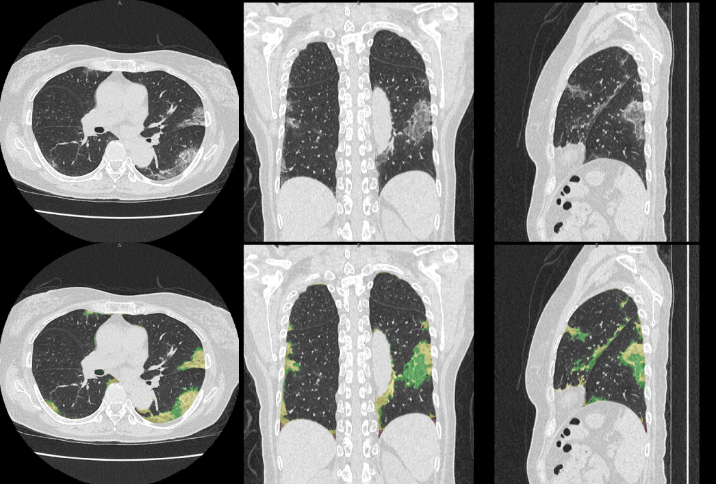 新型コロナ肺炎診断の支援技術、臨床への適用評価開始 大学ジャーナルオンライン