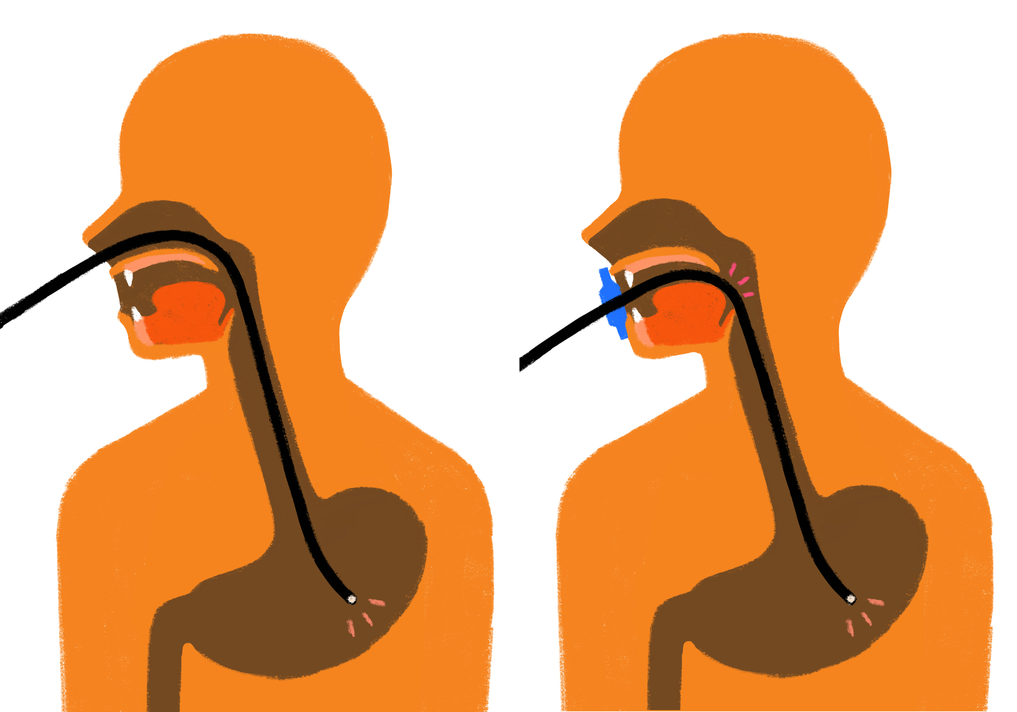 Simulation of costeffectiveness of gastric cancer endoscopy, end age