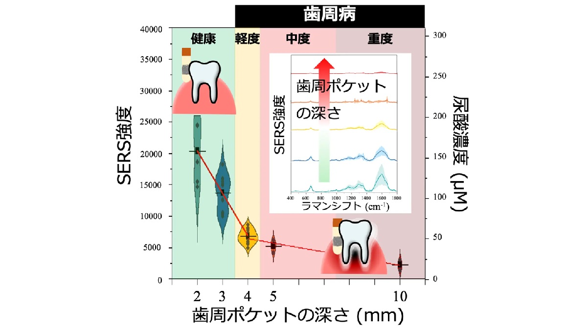 歯周病を早期発見できる安価・簡便な診断法 東京科学大学・東京大学