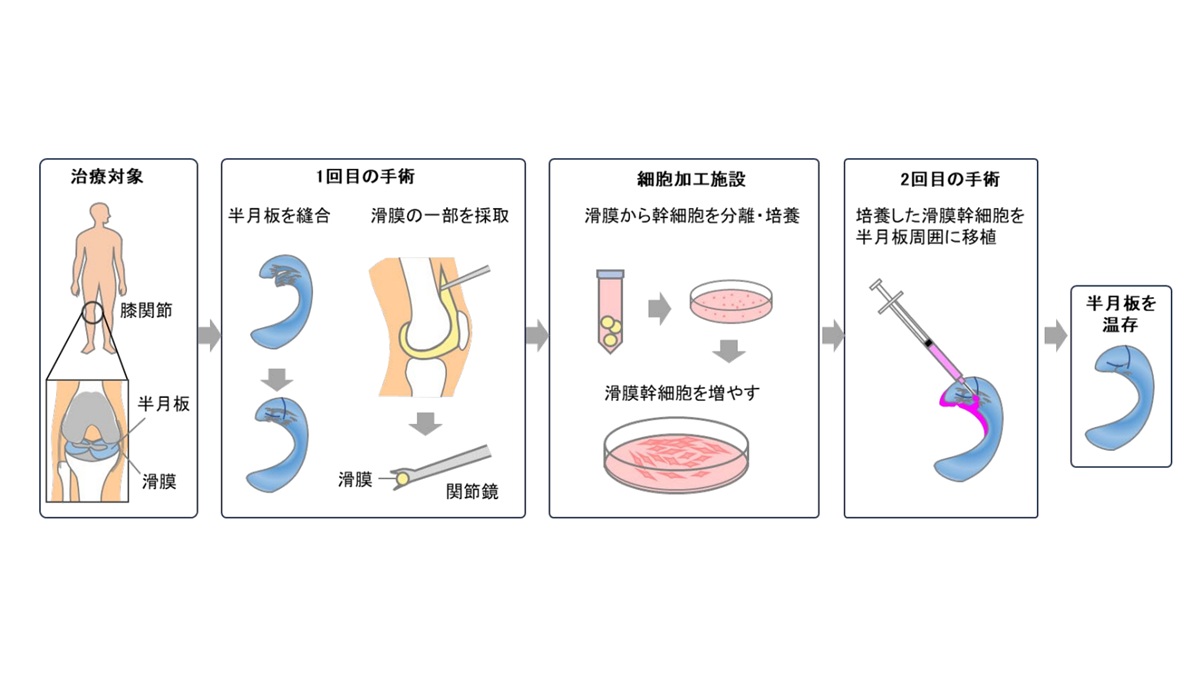 東京科学大学発の半月板再生医療技術が実用化へ － 患者自身の細胞で